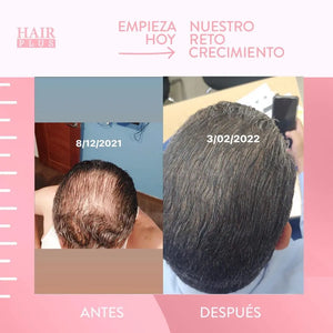 Kit para Hombres / Man's Hair Loss Control Bundle